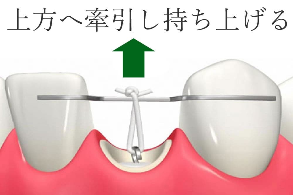 なるべく抜かない治療